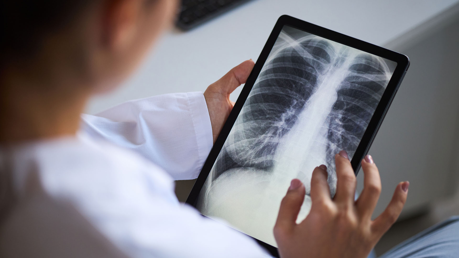 Young nurse looking at x-ray of lungs for tuberculosis
